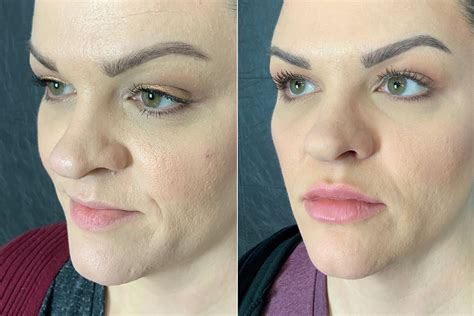 Lip Fillers Guide Types Of Lip Injections Costs Side 50 Off