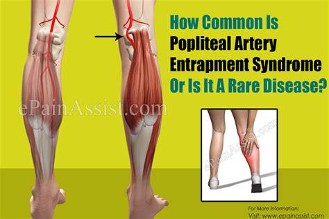 How Common Is Popliteal Artery Entrapment Syndrome Or Is It A Rare Disease
