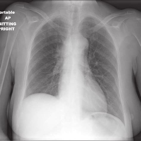 Chest X Ray Demonstrating An Elevated Right Hemi Diaphragm Mediastinal