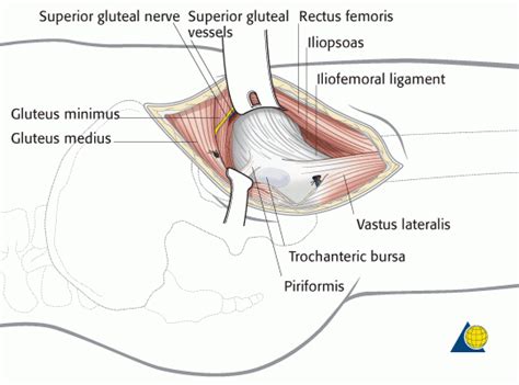 Surgical Approaches In Total Hip Replacement Mr Ilan Freedman