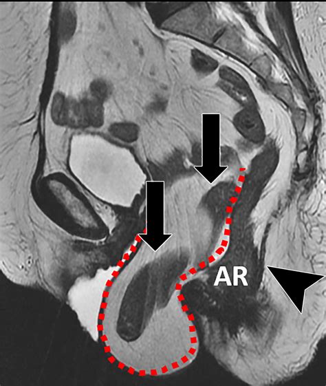 Translabial Us And Dynamic Mr Imaging Of The Pelvic Floor Normal