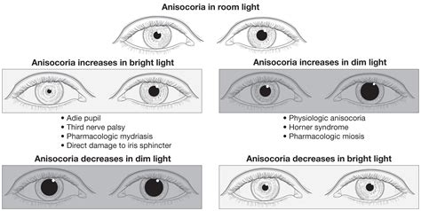 Anisocoria American Academy Of Ophthalmology