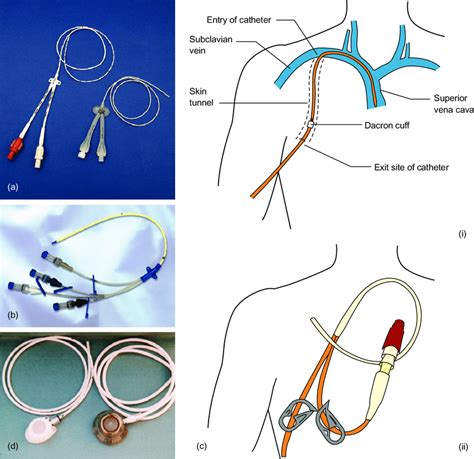 what are the different types of central venous cathet