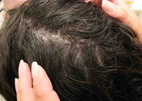 12 Cara Menghilangkan Kutu Rambut Secara Alami Serta Mencegahnya Datang