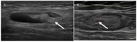 Cancers Free Full Text Oncologic Imaging Of The Lymphatic System