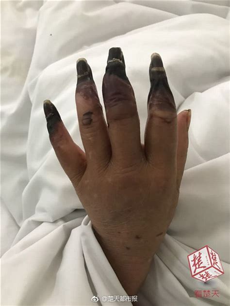 Woman Horrified As Eight Of Her Fingers Turn Black After Doing