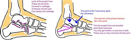 Broken Heel Bone Calcaneus Fracture — Bone Talks