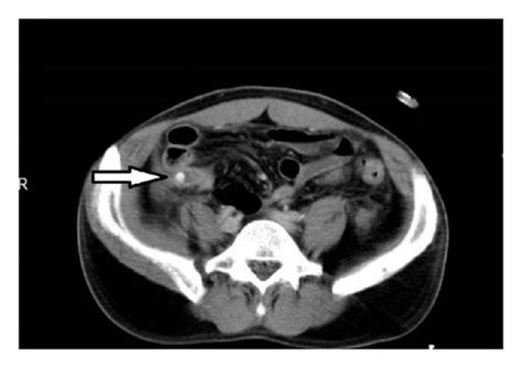 Iv Contrast Enhanced Axial Abdominal Ct Images Of A 43 Year Old Man