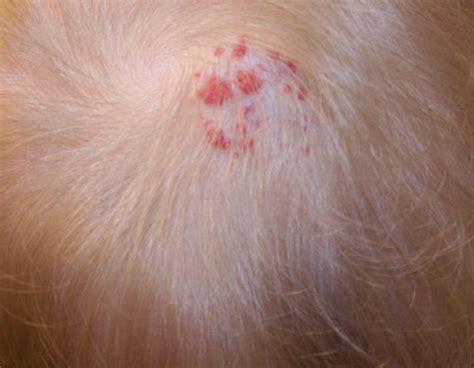 Itchy Bumps On Scalp Treatment Pictures Symptoms Causes 2018