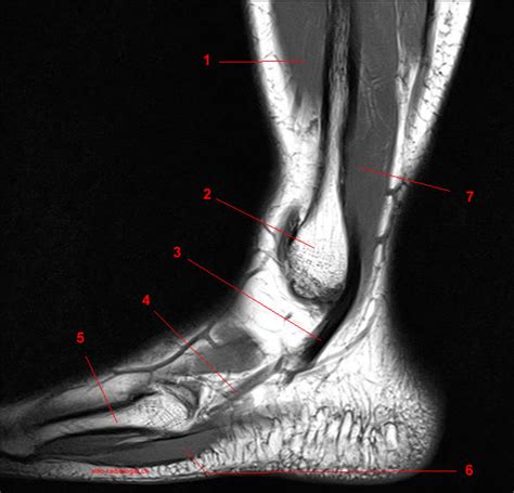 Plantar interossei (foot) dr yuranga weerakkody ◉ and dr geon oh et al. Anatomie IRM de la cheville