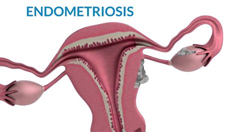 Endometriosis Surgery What To Expect After Laparoscopy Treatment