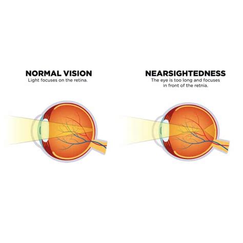 Top 5 Causes Of Blurred Vision Symptoms And Treatment Simvey