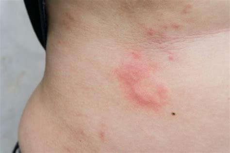 Puppp Skin Rash During Pregnancy Symptoms And Causes