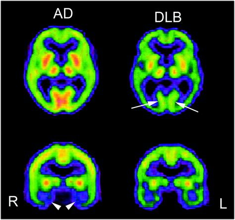 Role Of Neuroimaging In Alzheimers Disease With Emphasis On Brain