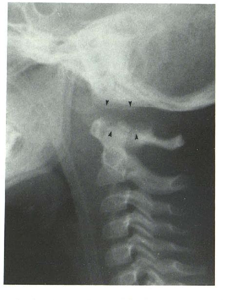 Figure 1 From Traumatic Longitudinal Atlanto Occipital Distraction