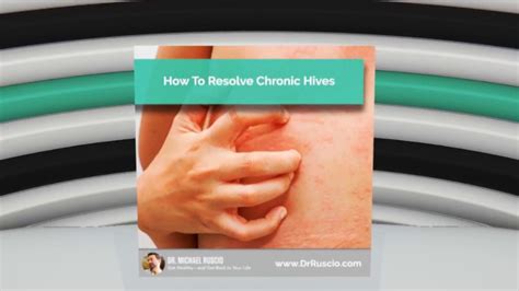 How To Resolve Chronic Hives Audience Question Youtube