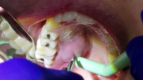 Awasome How To Drain A Tooth Infection At Home Ideas Merge Wiring