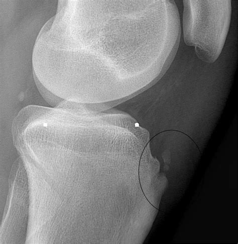 Arthroscopic Excision Of An Osgood Schlatter Ossicle Kneeguru