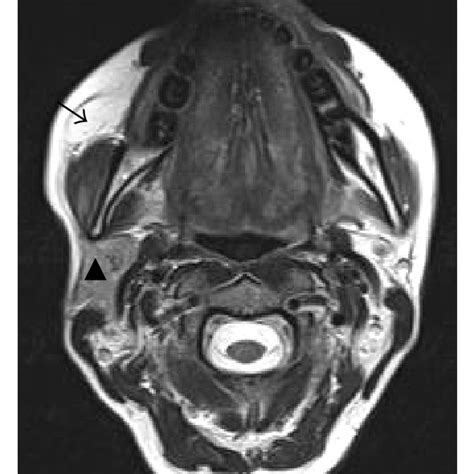 Mri Scan Of The Parotid Gland Shows The Unilateral Agenesis Of The