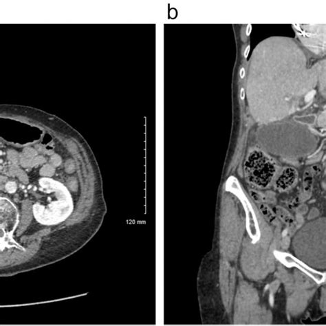 Preoperative Ct Scan Of The Abdomen And Pelvis With Iv Contrast