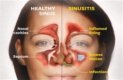 Kill Sinus Infection In 20 Seconds With This Simple Method And This Common Household Ingr