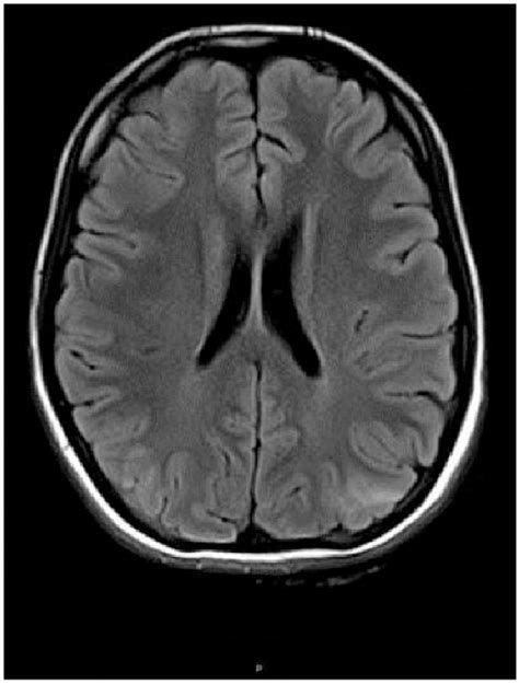 Parieto Occipital Swelling Showing Multiple Non Enhancing White Matter