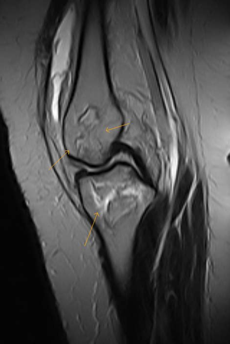 Knee Avascular Necrosis Mri Sumer S Radiology Blog