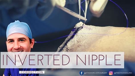 Inverted Nipple Correction Surgery Before And After Youtube