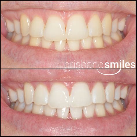 Teeth Whitening Photos Brisbane Smiles