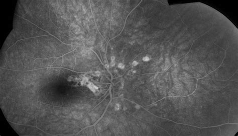 Angioid Streaks Outlook Eye Specialists