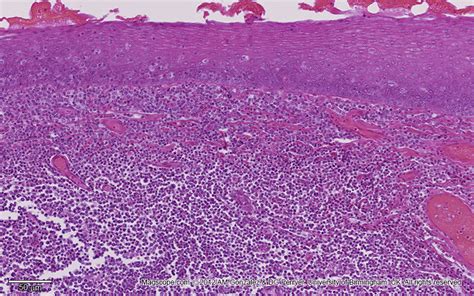 Low Magnification Image Of A Lingual Tonsil Covered By Stratified
