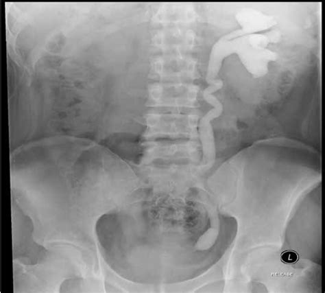 A Intravenous Pyelogram Showing Moderate Left Hydronephrosis And