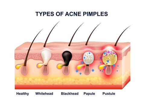 Learn The 4 Types Of Acne The Symptoms And How You Can Treat Them