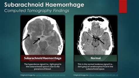 Subarachnoid Hemorrhage Sah Computed Tomography Scan Findings Youtube