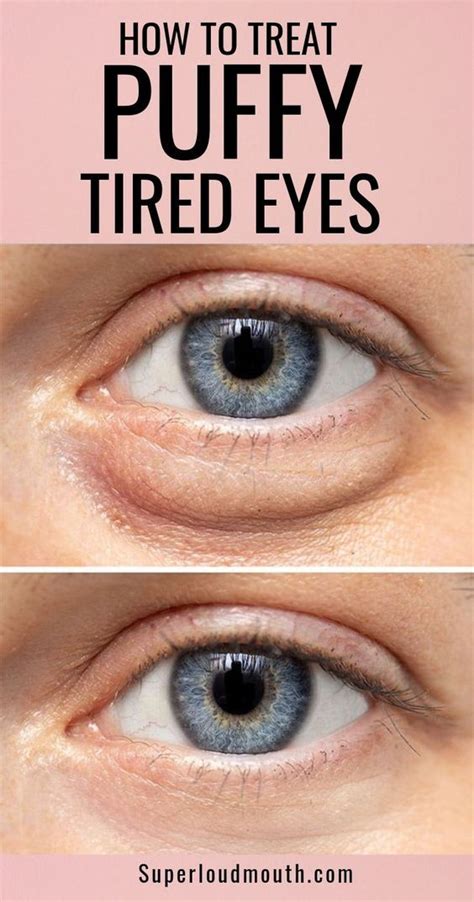 What Your Eye Bags Tell About Your Health How To Get Rid Of Them