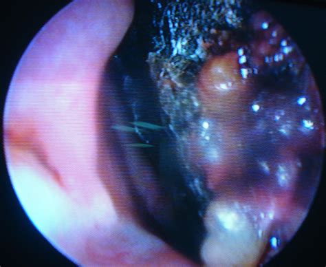 Gard answers gard answers listen. 2011.1-5.Mucormycosis | Our Dermatology Online journal