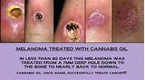 Marijuana Oil For Cancer Pictures