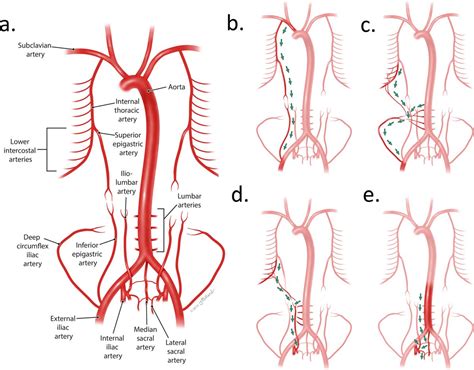 Anatomical Significance In Aortoiliac Occlusive Disease Semantic Scholar