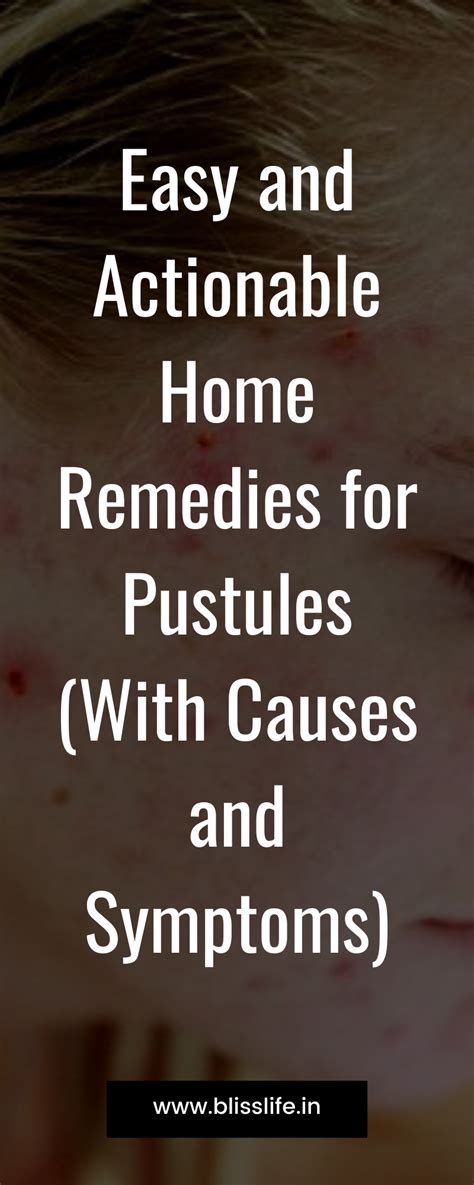In This Article I Have Shared Some Home Remedies For Pustules Let Me