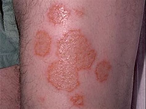 Atopic Dermatitis Eczema And Noninfectious Immunodeficiency Disorders