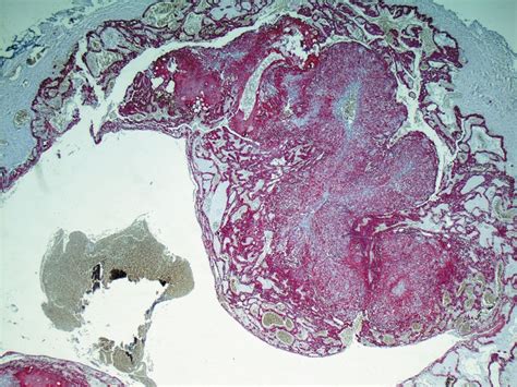 Adenomatoid Odontogenic Tumor A Case Report With Immunohistological