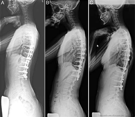 Cervical Lordotic Alignment Following Posterior Spinal Fusion For