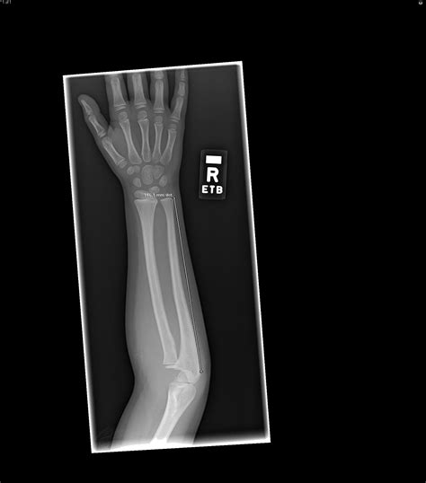 List 104 Images X Ray Of Right Hand And Wrist Full Hd 2k 4k