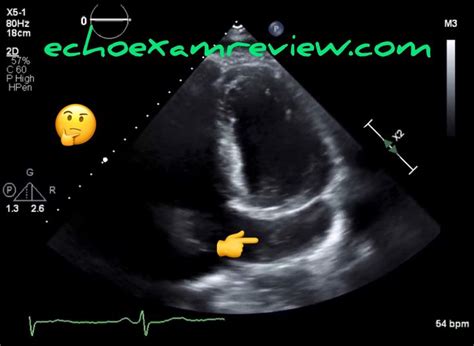 Pin On Echocardiography