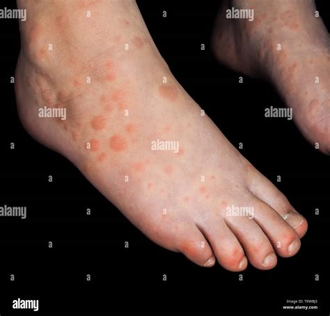 Child With Red Rash From Coxsackievirus On Both Feet Isolated On