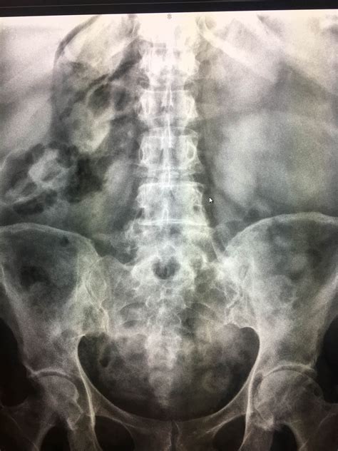 Right Upper Quadrant Abdominal Pain Radiology