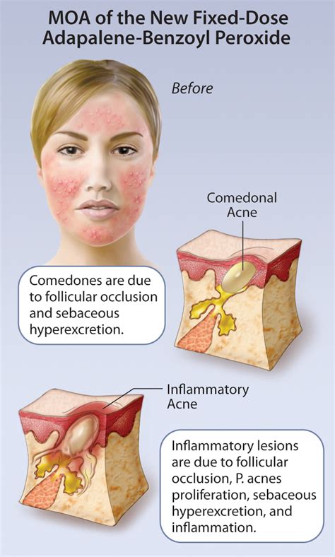 New Developments In The Topical Management Of Acne