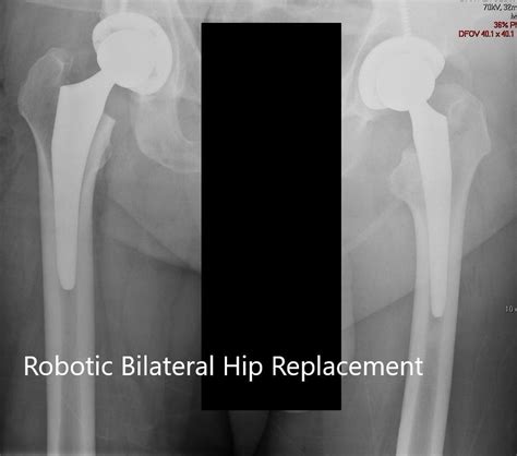 Case Study Bilateral Hip Replacement In 65 Yr Old Female