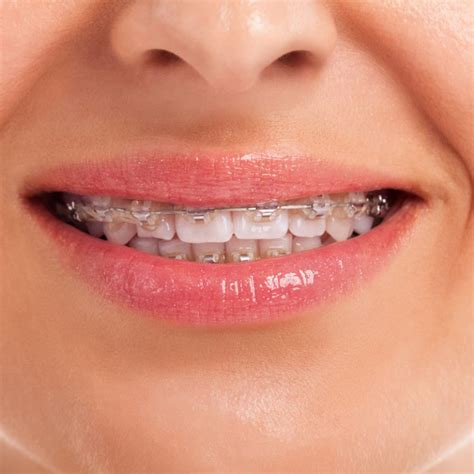 Need Dental Braces Or Orthodintic Treatment In Etobicoke On
