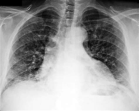 Preoperative Chest X Ray Cxr Preoperative Cxr Demonstrated Bilateral